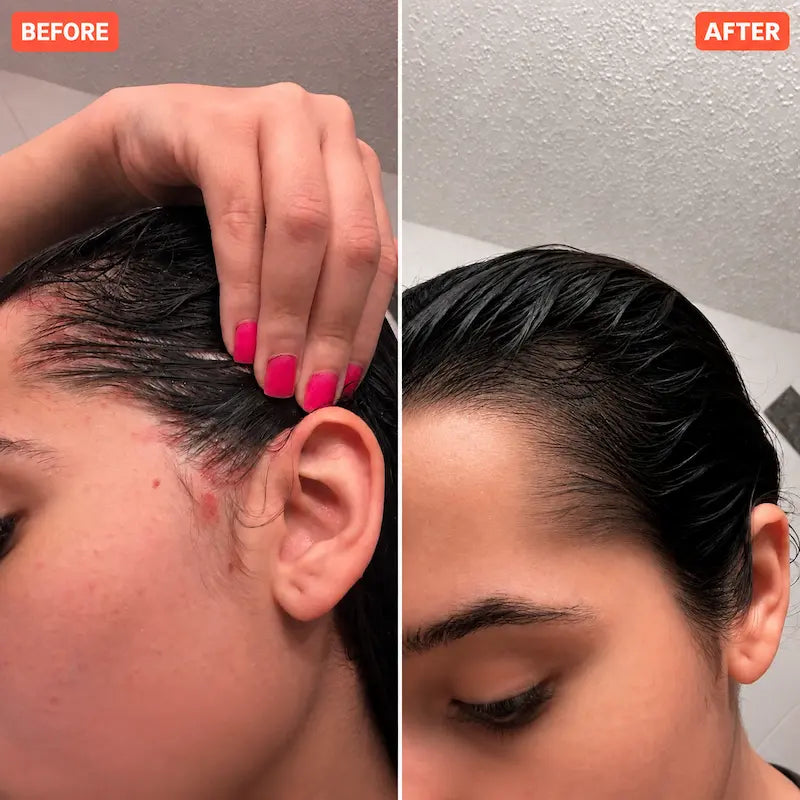 istylr scalp reset - Nine Tines